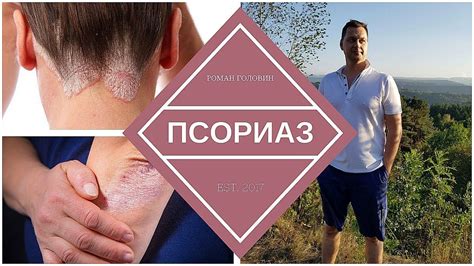 Псориаз. Истинные причины Псориаза и лечение | Истины, Медицина, Врачи