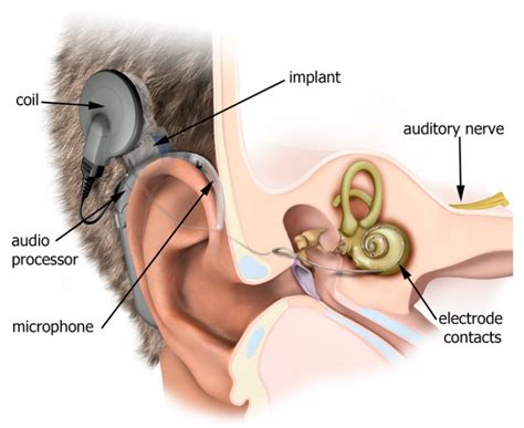 Machine Learning and Cochlear Implantation: Predicting the Post