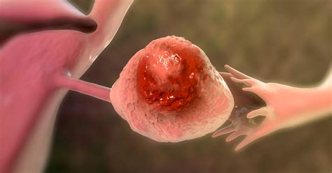 Opportunistic fallopian tube removal recommended to prevent ovarian cancer