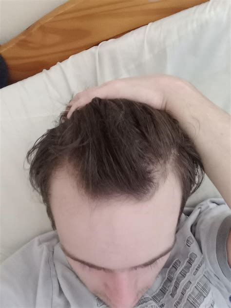 how to know if your hairline is receding 4