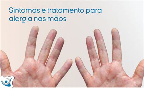Alergia A Detergente Nas Mãos - Sintomas e tratamento para alergia nas mãos - Alergoclínica