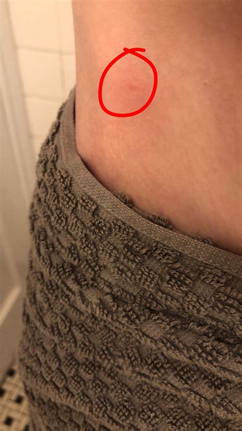 Can anyone identify bumps like this? been using steroid cream as well