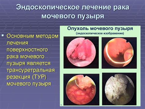 Рак мочевого пузыря - презентация онлайн