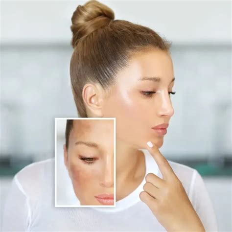 Effective Dark Spot Removal for Flawless Skin