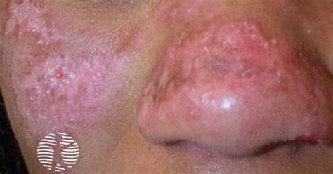 Cutaneous lupus erythematosus image