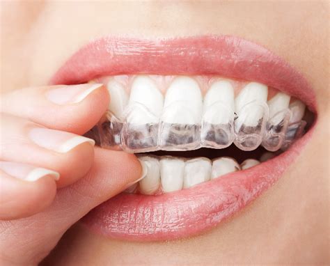 Избелване на зъби | Новини | Dental.bg