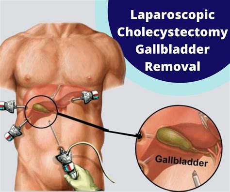 gerd  gallbladder removal vyjsbi