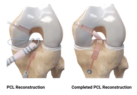 PCL Surgery