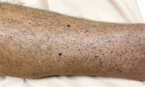 Idiopathic thrombocytopenic purpura pipeline innovation in Asia-Pacific