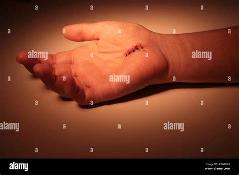 Hand with stitches from carpal tunnel surgery Stock Photo - Alamy