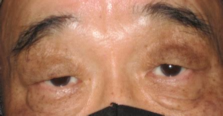 Oculoplastic - Blepharoplasty | Polaris Eye & Laser