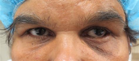 Entropion — Dr Ye Chen · Oculoplastic Surgeon & Ophthalmologist · Melbourne