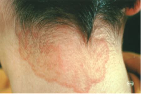 Ringworm Rash Causes