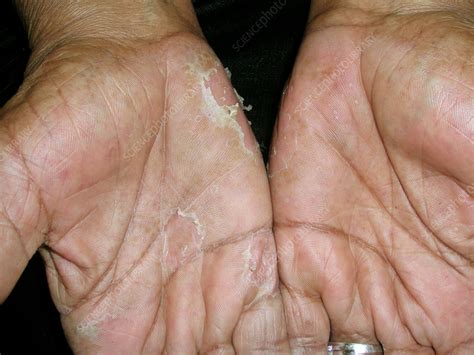 Dyshidrotic Eczema And Food Allergies at Ethan Fuhrman blog