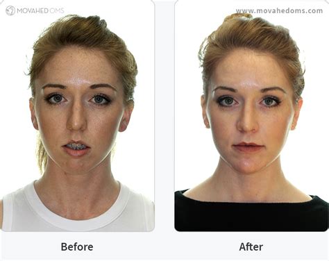 TMJ Surgery Before And After