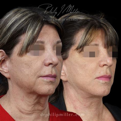 revision facelift   york philip  miller md facial plastic
