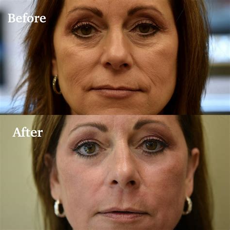patient  laser resurfacing    pekomd