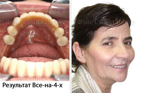 Случай 3. Дентальная имплантация с установкой восьми имплантатов на ...