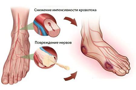 Газовая гангрена – симптомы, формы и методы лечения