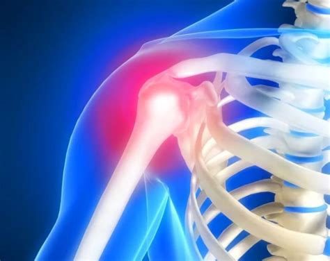 Плечелопаточный периартрит: причины, симптомы ⋆ vertebrology.ru