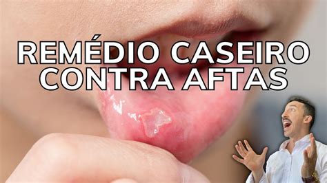 O'que Passar Na Afta - Melhores Remedios Para Afta - RETOEDU