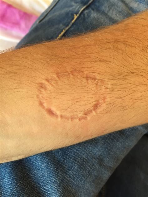 What Are The 7 Types Of Bite Marks at Michael Mahoney blog