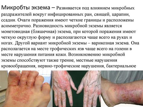 Экземаның клиникалық көрінісі - презентация онлайн