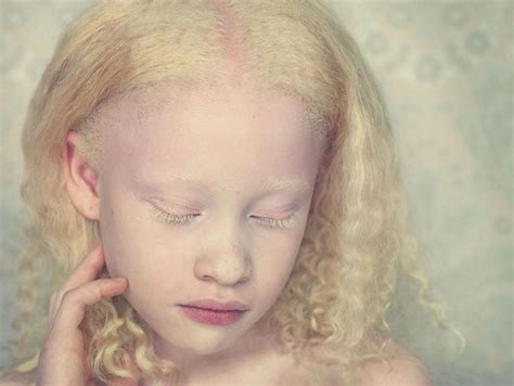 Albinism, in Portraits - The Atlantic