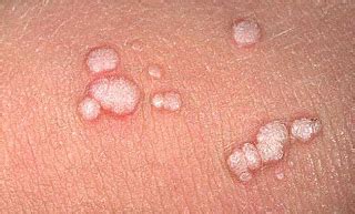 Plantar Warts On Heel : Moles , Warts and Skin Tags Removal. | Wart ...