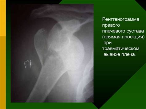 Повреждение плеча, вывихи плеча и предплечья - презентация онлайн