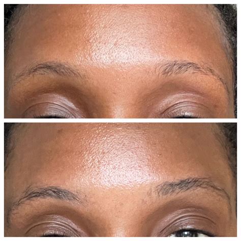 1269 best Minoxidil images on Pholder | Female Hair Loss, Tressless and