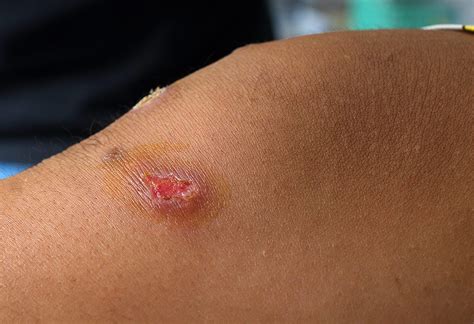Impetigo in Kids - Types, Causes, Signs & Home Remedies