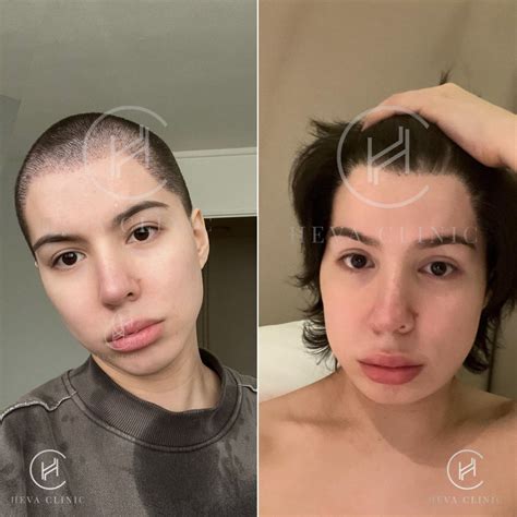 mtf transgender hair transplant process  costs
