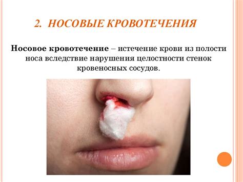 Травмы носа и носовые кровотечения - презентация онлайн