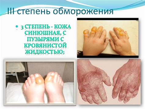 Обморожение. Первая помощь при обморожении - презентация онлайн