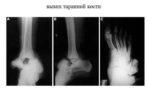 Рентген — диагностика повреждений стопы