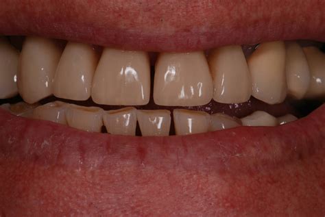 Emax 12-23 Before and After - Gold & Ceramics