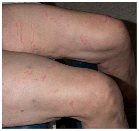 rapid development  migratory linear  serpiginous lesions