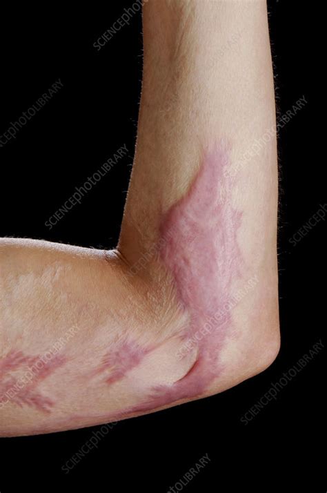 Burns scar - Stock Image - C025/8054 - Science Photo Library