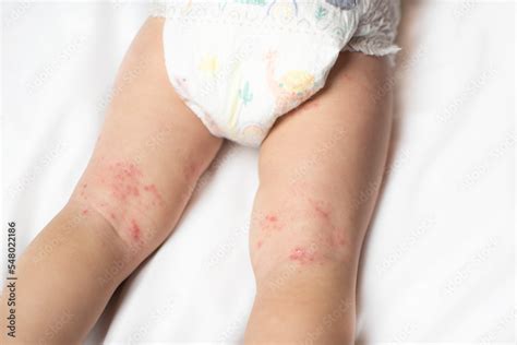 Hand, Foot, and Mouth disease rash on a baby's legs. Coxsackie virus ...