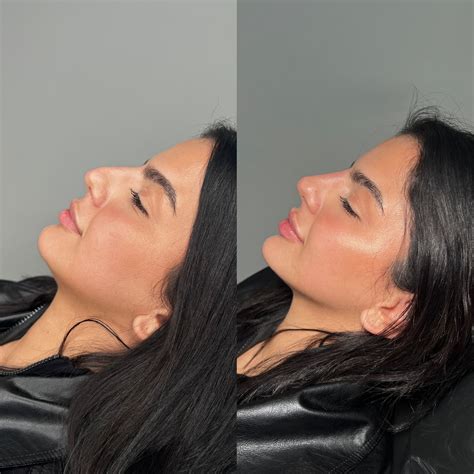 Nose Job Before and After: A Complete Guide to Rhinoplasty Transformations