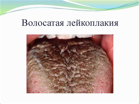 Абсцессы ретромолярного пространства, ВИЧ-инфекция - презентация онлайн