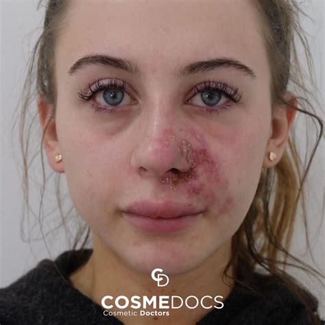 Dead Lips From Too Much Filler | Lipstutorial.org