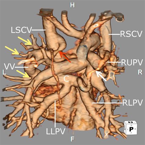 pulmonary venous abnormalities clinical tree