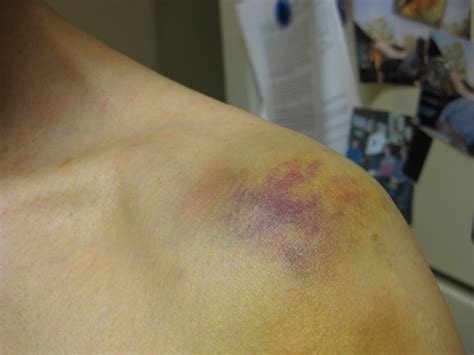 Leukemia Bruises Back