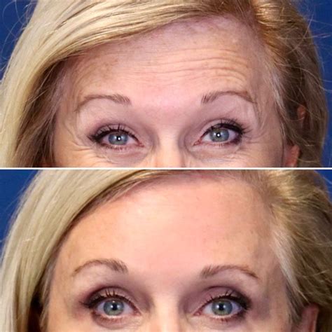 Botox forehead before after | Botox forehead, Botox, Botox injections