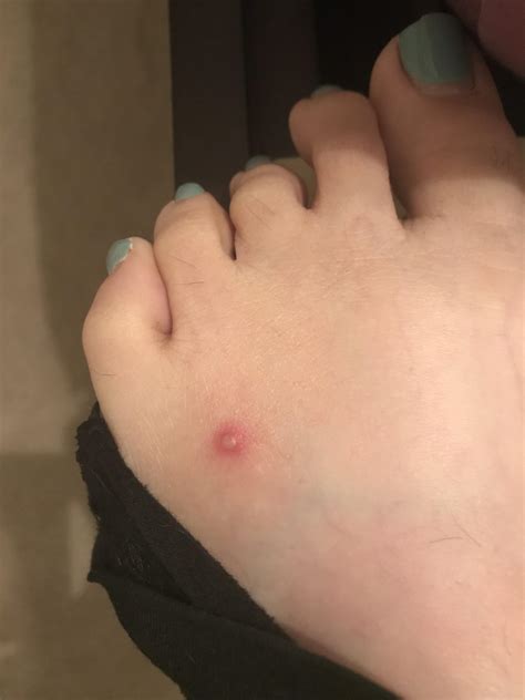 Infected Fire Ant Bites