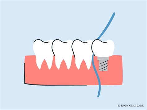 How to Floss Dental Implants: Essential Techniques