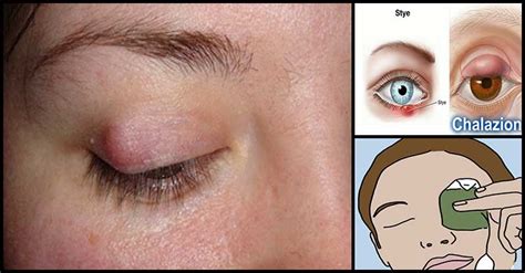 oral chalazion treatment chalazion treatment  home management