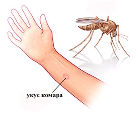 Укус комара: как снять отёк, лечение, помощь детям